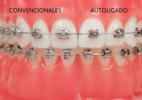 autoligado vs brackets convencionales